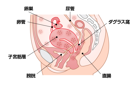内 膜 掻爬 子宮 子宮内膜全面掻爬術で癌細胞が採れない確率はどのくらいでしょうか？
