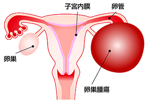 卵巣腫瘍 | 横浜市青葉区の婦人科内視鏡手術センター